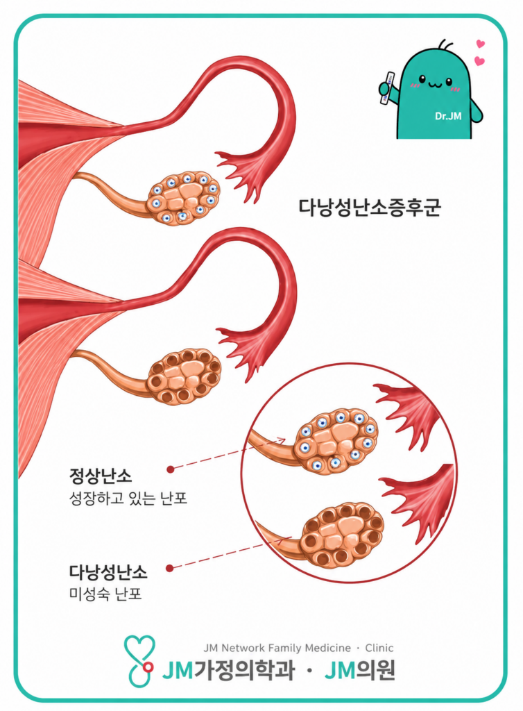 다낭성 난소 증후군