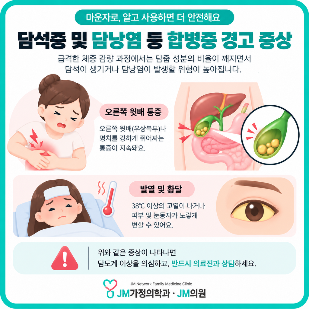 마운자로담석증
